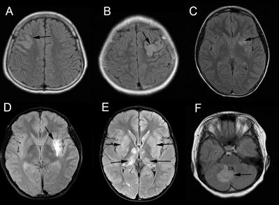 Clinical characteristics of myelin-oligodendrocyte glycoprotein antibody-positive pediatric autoimmune encephalitis without demyelination: A case series